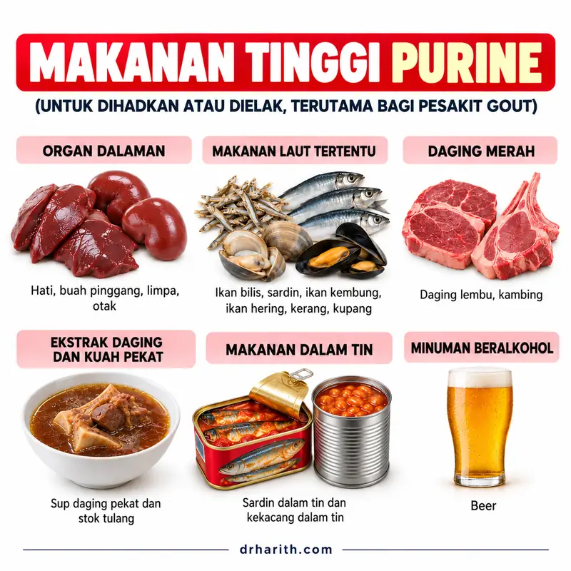 Infografik makanan tinggi purine yang perlu dihadkan atau dielak dalam gout: organ dalaman, makanan laut tertentu, daging merah, ekstrak daging dan kuah pekat, makanan dalam tin, dan minuman beralkohol