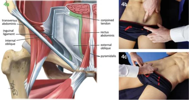 Layered diagram of the inguinal region labelling the iliopsoas, inguinal ligament, internal oblique and conjoint tendon, together with clinical photographs showing deep palpation of the inguinal canal