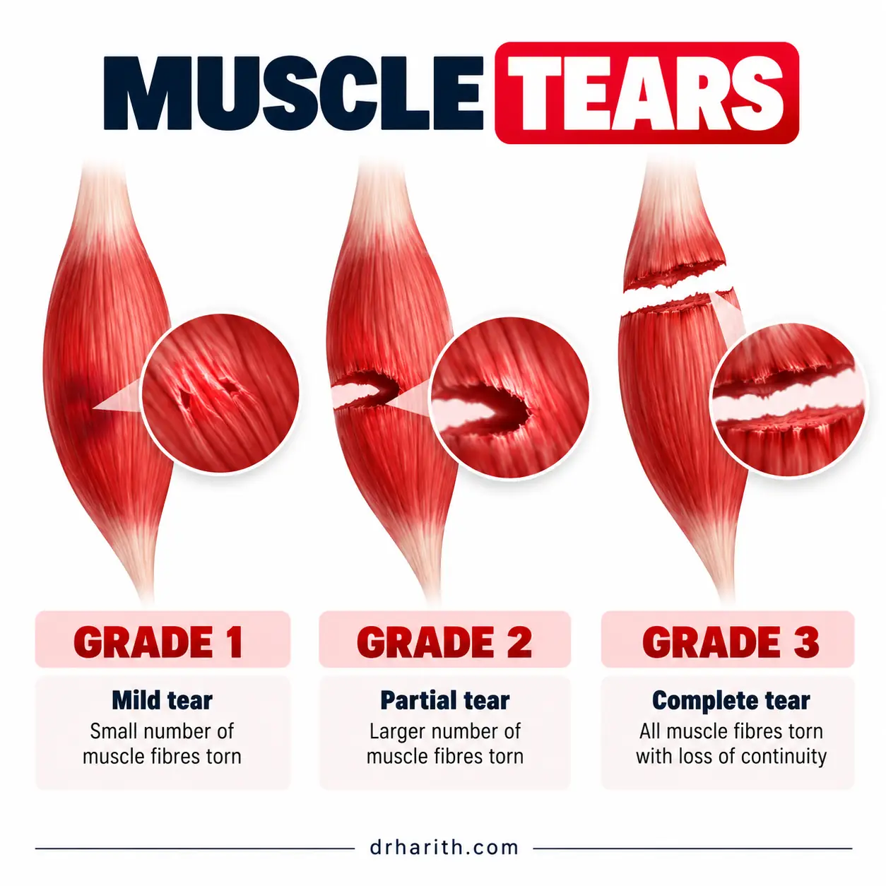 Infografik tiga tahap koyakan otot: tahap 1, sebilangan kecil gentian otot koyak; tahap 2, koyakan separa; dan tahap 3, koyakan penuh dengan kehilangan kesinambungan otot